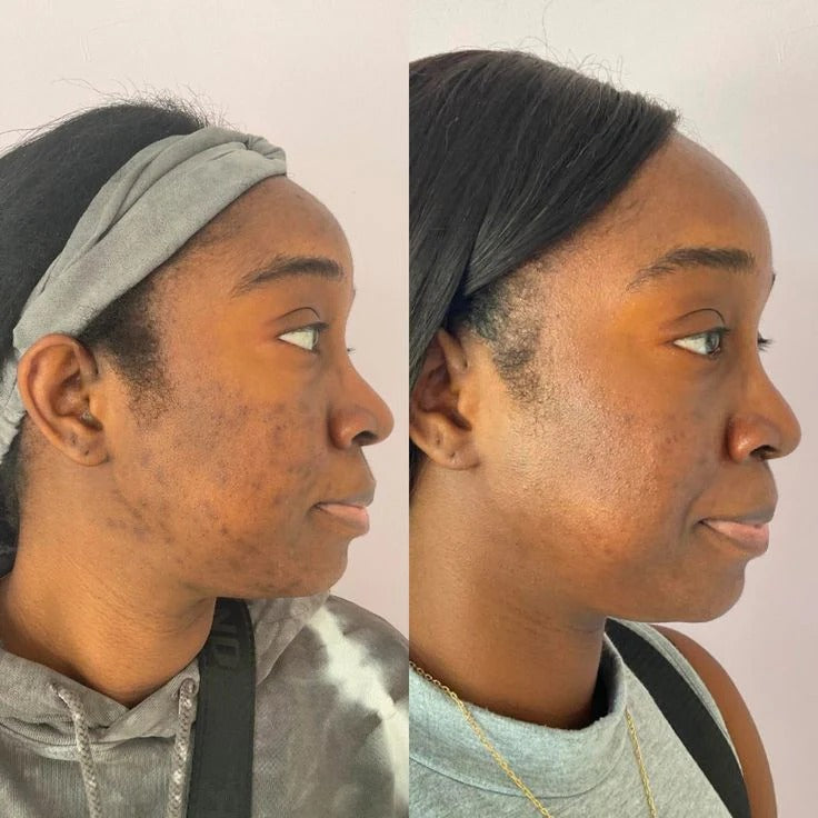 Kojic Acid & Turmeric Soap